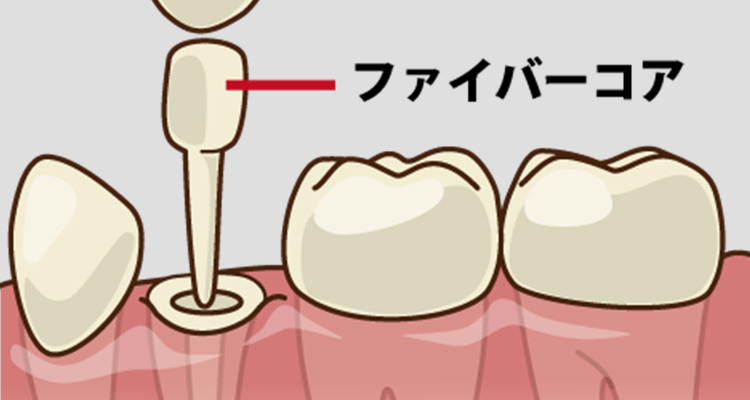 コア ファイバーコア