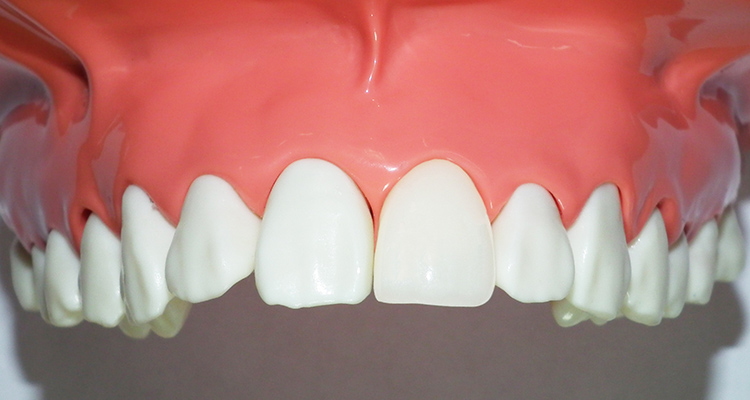 前歯の被せ物（クラウン） ジルコニア