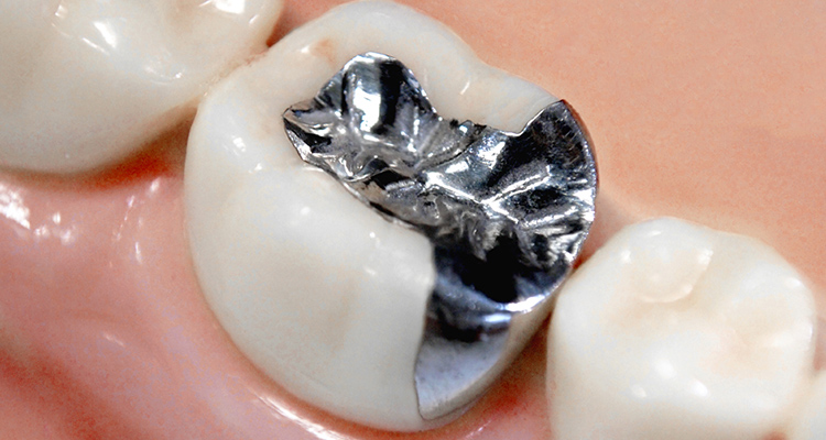 インレー 金銀パラジウム合金