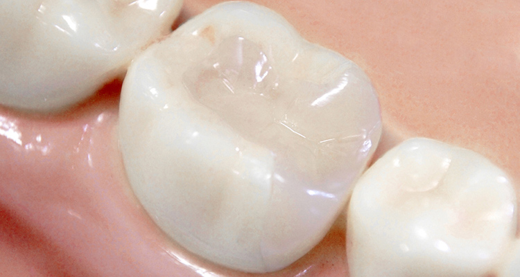 インレー セラミック