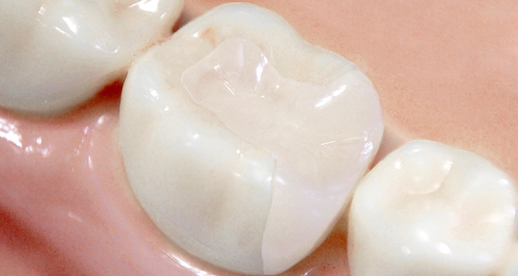 インレー ジルコニア